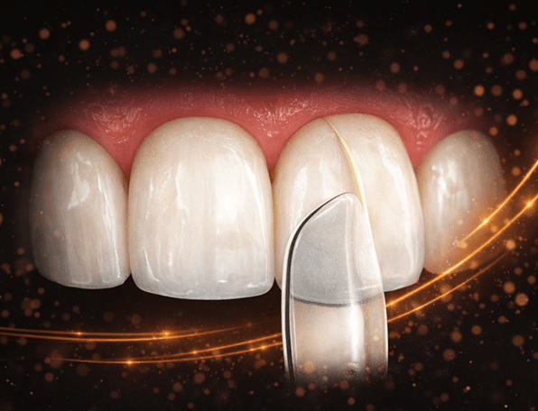 Composite Bonding
